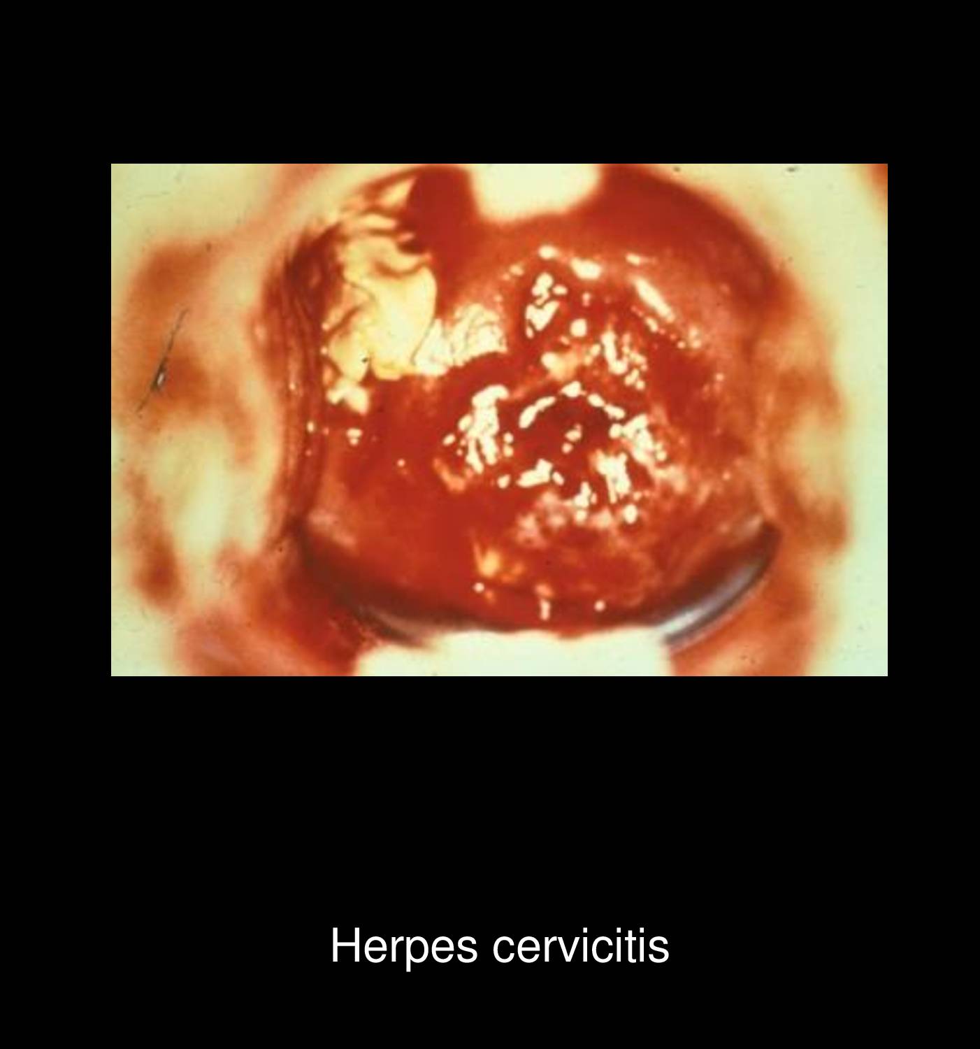 Herpetic whitlow on finger showing painful vesicular lesions with surrounding erythema caused by autoinoculation of herpes simplex virus